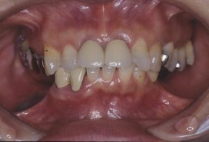 歯周病　矯正　インプラント　セラミック等を用いて治療を行う前の画像