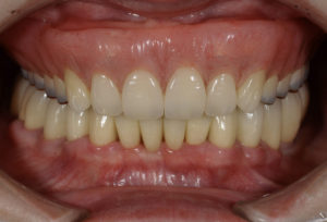 歯周病に対して、歯周外科手術、矯正、インプラント、再生療法等の治療を行なった後の画像