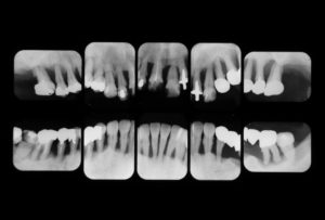 歯周病の治療を行う前のレントゲン写真