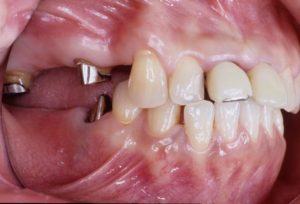 歯周病　矯正　インプラント　セラミック等を用いて治療を行う前の画像