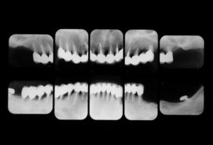 歯周病に対して、歯周外科手術、矯正、インプラント、再生療法等の治療を行なった後のレントゲン画像