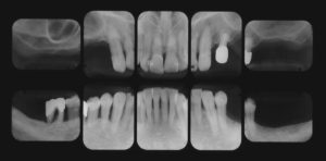下関市のおおむら歯科医院にて、右上右下、左上左下の奥歯にインプラント治療を行う前のレントゲン画像