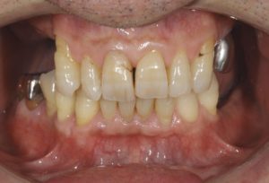下関市のおおむら歯科医院にて、右上右下、左上左下の奥歯にインプラント治療を行う前の画像