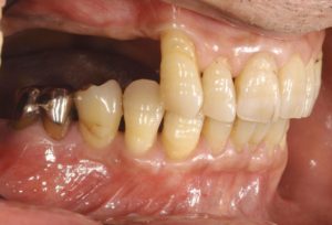 下関市のおおむら歯科医院にて、右上と右下の奥歯にインプラントの治療を行う前の画像