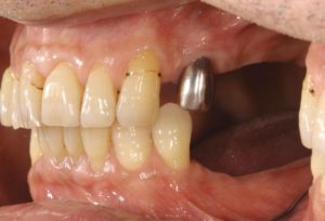 下関市のおおむら歯科医院にて、左上と左下の奥歯にインプラントの治療を行う前の画像