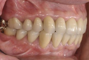 歯周病　矯正　インプラント　セラミック等を用いて治療を行った後の画像
