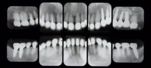 歯周病　矯正　インプラント　セラミック等を用いて治療を行った後のレントゲン画像