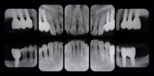 下関市のおおむら歯科医院にて、右上右下、左上左下の奥歯にインプラント治療を行った後のレントゲン画像