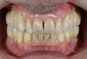下関市のおおむら歯科医院にて、右上右下、左上左下の奥歯にインプラント治療を行った後の画像