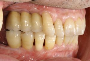 下関市のおおむら歯科医院にて、右上と右下の奥歯にインプラントの治療を行った後の画像