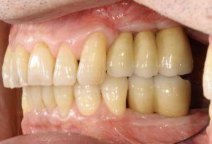 下関市のおおむら歯科医院にて、左上と左下の奥歯にインプラントの治療を行った後の画像