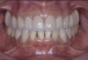 歯周病　矯正　インプラント　セラミック等を用いて治療を行った後の画像