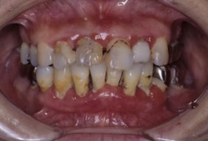 歯周病の治療を行う前の画像