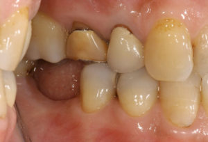 右下の奥歯にインプラントの治療を行う前の画像