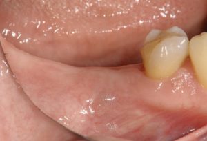 下関市のおおむら歯科医院にて、右下の奥歯にインプラントの治療を行う前の画像