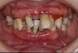 歯周病に対して、歯周外科手術、矯正、インプラント、再生療法等の治療を行う前の画像