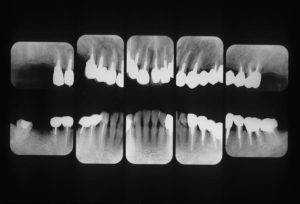 歯周病　矯正　インプラント　セラミック等を用いて治療を行う前のレントゲン画像