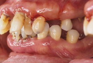 歯周病に対して、歯周外科手術、矯正、インプラント、再生療法等の治療を行う前の画像