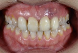 上顎の前歯にセラミックを用いた審美歯科治療を行う前の写真