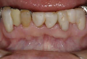 下顎の前歯にセラミックを用いた審美歯科治療・矯正治療を行う前の写真