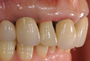 右上の前歯にラミネートベニアを用いたセラミック治療を行う前の写真