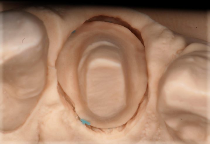下関市のおおむら歯科医院にてセラミック治療のために支台歯の模型を作製した写真