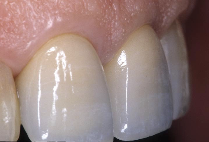 下関のおおむら歯科医院で実際に治療したセラミックを用いた審美歯科治療。