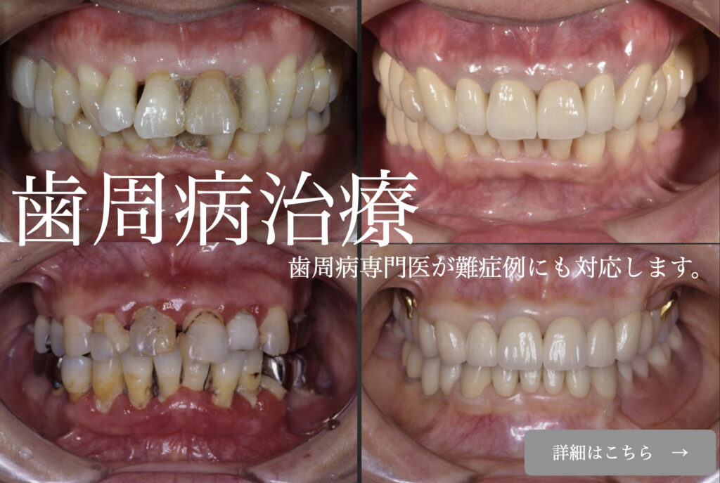 下関市のおおむら歯科医院　　歯周病の再生治療　セラミック　フラップ手術　インプラント　矯正治療を行なった。