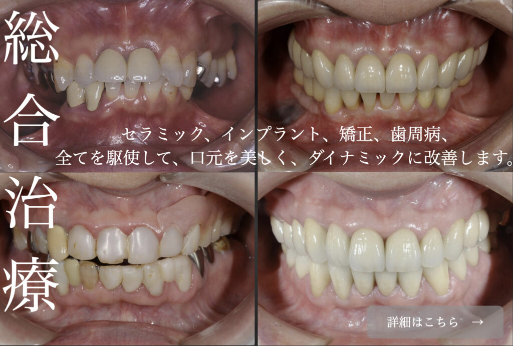 山口県下関市　下関駅前　おおむら歯科医院の総合治療。インプラント、セラミック、歯周病、矯正を用いて口元を美しく改善します。